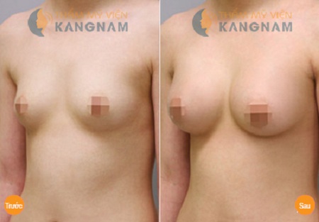 Zoom cận cảnh quy trình phẫu thuật nâng ngực nội soi