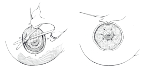 Kỹ thuật thu nhỏ quầng vú hiện đại tại Kangnam phau thuat thu nho quang vu co an toan khong