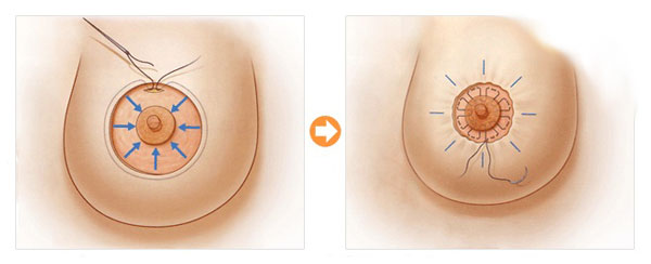 Thu nhỏ quần vú có an toàn không? trở thành thắc mắc của hàng ngàn chị em Phẫu thuật thu nhỏ quầng vú có an toàn không