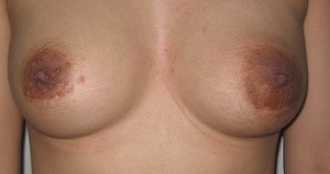 Quầng vú rộng lên sau khi sinh con trở thành nỗi ám ảnh của phái đẹp thu nhỏ quầng vú có an toàn không