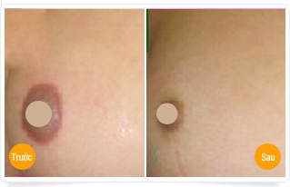 Giúp bạn tự tin hơn với quầng vú nhỏ đẹp, cân đối thu nho quang vu co an toan khong