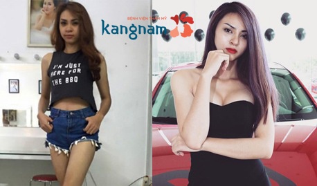 ảnh trước & sau nâng ngực Người mẫu Kim Anh