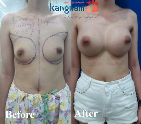 kết quả khách hàng sau nâng ngực tại kangnam