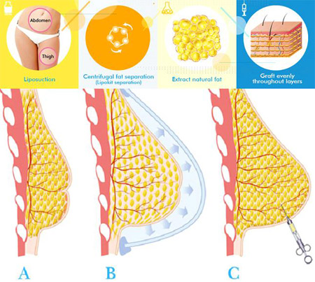 Phẫu thuật nâng ngực bằng mỡ tự thân có an toàn không