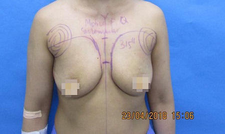 Phẫu thuật nâng ngực chảy xệ giá bao nhiêu987