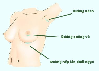 Các đường rạch thường được lựa chọn để đưa túi ngực vào bên trong 5