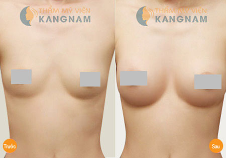 Ngực sau khi nâng bằng công nghệ Y-Line trông có tự nhiên không?