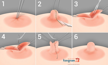 phẫu thuật kéo núm vú bị tụt có đau không? 1