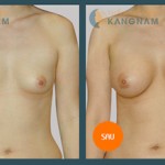 Phẫu thuật nâng ngực và những điều bạn nên lưu ý?