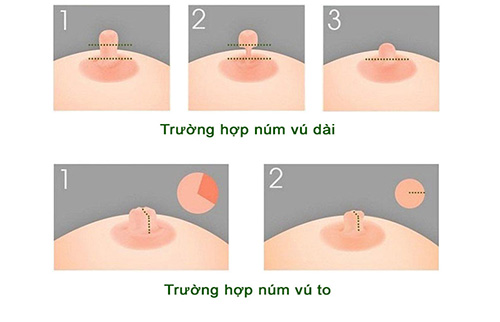 Thu nhỏ nhũ hoa ở đâu tốt nhất