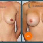 Tổng hợp chi phí phẫu thuật nâng ngực tại TMV Kangnam?