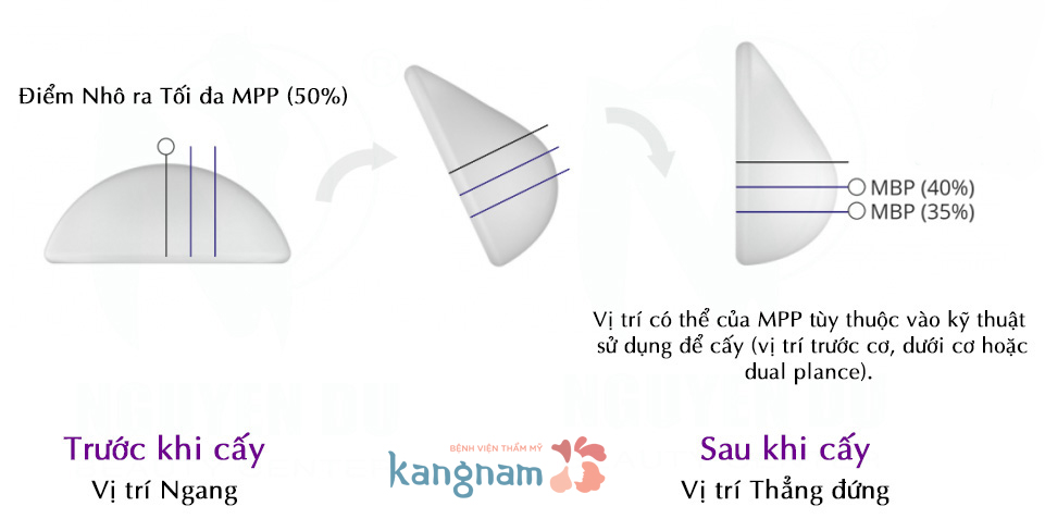 tui-don-nguc-nano-chip-la-gi-nhung-dieu-chua-duoc-tiet-lo-4