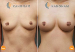 công nghệ nâng ngực Hàn Quốc mới và được ưa chuộng nhất